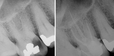 services-rootcanal